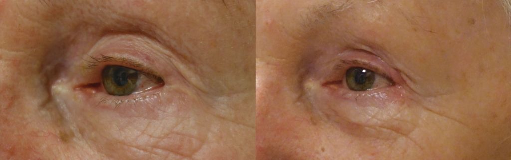 Left Lateral Canthal Web After Lower Eyelid Blepharoplasty - Repair with Micro Flap Revision Surgery Patient 03 