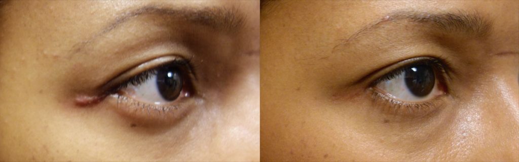 Right Lateral Canthal Keloid Scar After Eyelid Surgery - Repaired With In Office Non Surgical Revision Patient 02 
