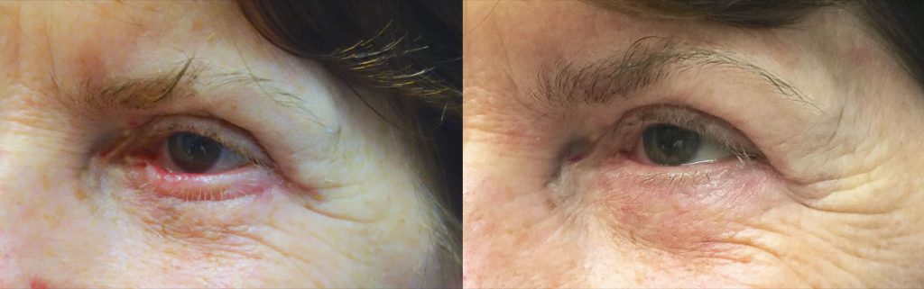 Scarring and Ectropion After Lower Eyelid Blepharoplasty - Non Surgical In Office Revision Patient 01 