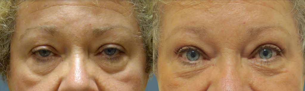 Bilateral External Upper Eyelid Ptosis Repair Patient 10 