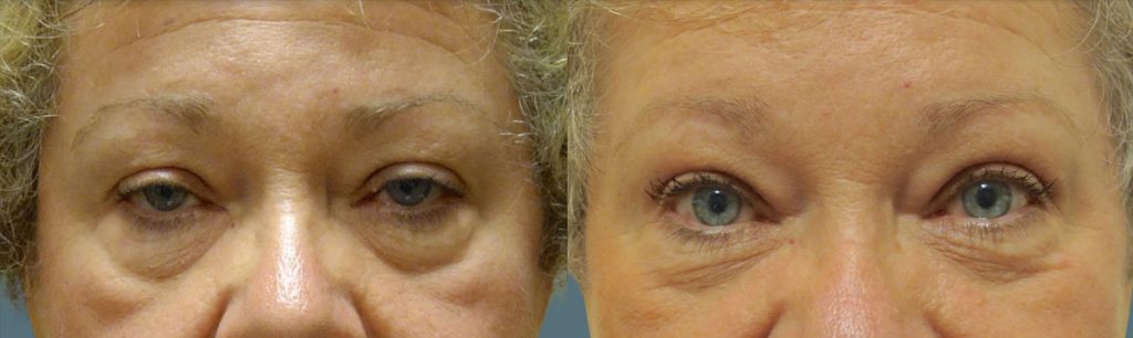 Bilateral External Upper Eyelid Ptosis Repair Patient 18 