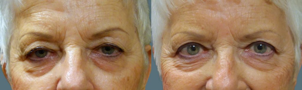 Bilateral Upper Eyelid Blepharoplasty, Bilateral Internal Ptosis Repair Patient 13-A 