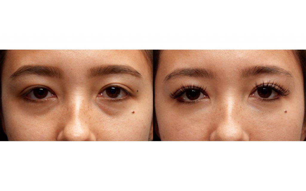 Bilateral Lower Eyelid Filler Asian Patient 06-C 