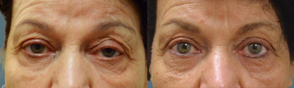 Bilateral Upper Eyelid Blepharoplasty, Bilateral Internal Ptosis Repair Patient 15 