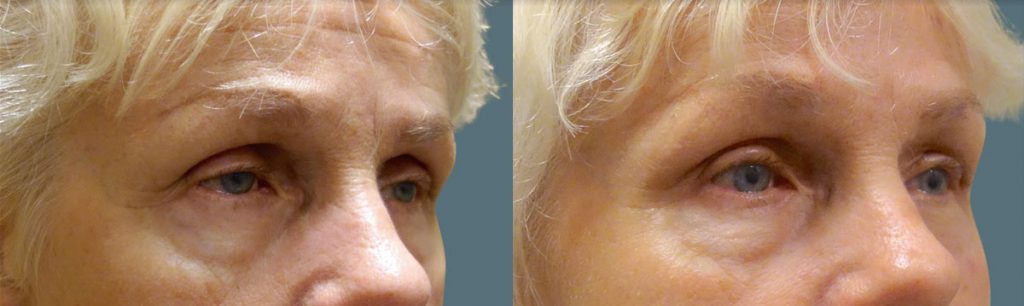 Bilateral Upper Eyelid External Ptosis Repair Patient 09-B 