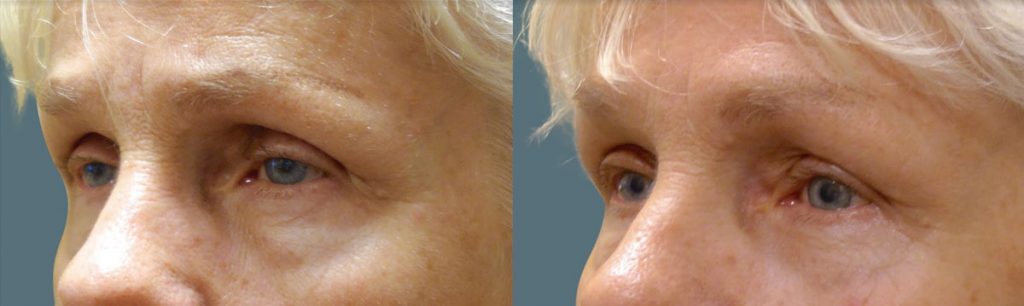 Bilateral Upper Eyelid External Ptosis Repair Patient 09-C 