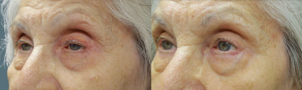 Bilateral Upper Eyelid External Ptosis Repair Patient 12-B 