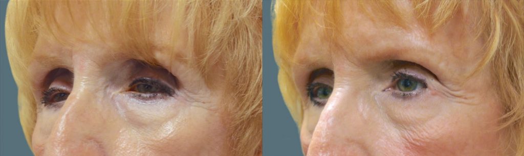 Bilateral Upper Eyelid External Ptosis Repair Patient 16-C 