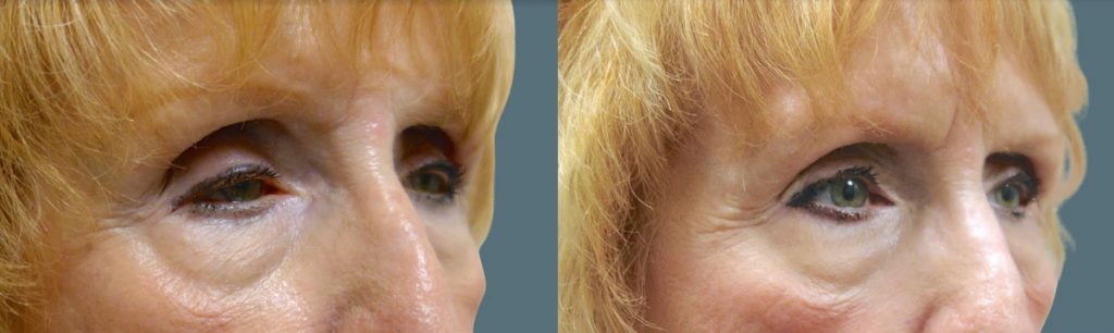 Bilateral Upper Eyelid External Ptosis Repair Patient 16-B 