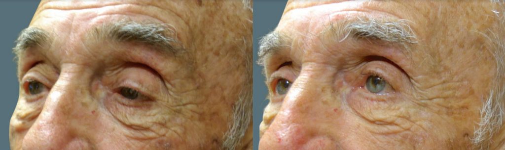 Left Upper Eyelid External Ptosis Repair Patient 10-B 