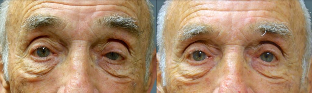 Left Upper Eyelid External Ptosis Repair Patient 10-A 