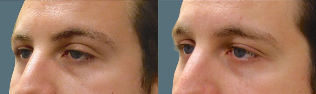 Left Upper Eyelid External Ptosis Repair Patient 05-B 