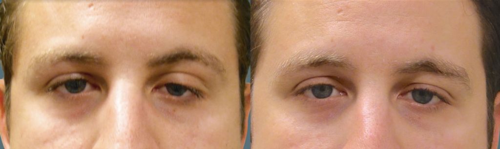 Left Upper Eyelid External Ptosis Repair Patient 05-A 