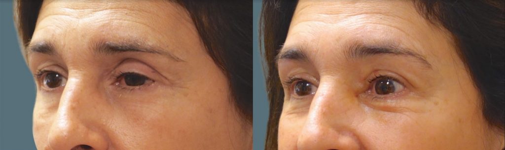 Left Upper Eyelid External Ptosis Repair Patient 06-B 