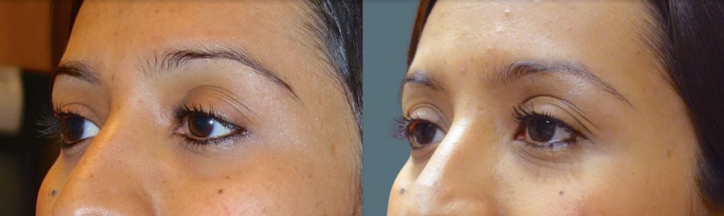 Left Upper Eyelid External Ptosis Repair Patient 07-B 