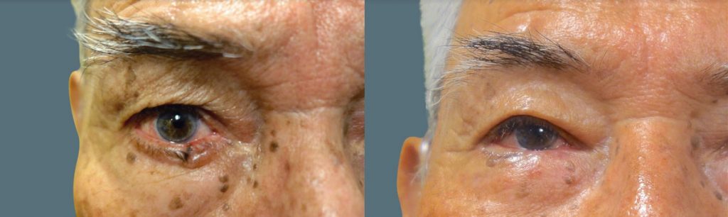 Right Lower Eyelid Basal Cell Carcinoma with (Multiple Stage) Reconstruction Patient 03-A 