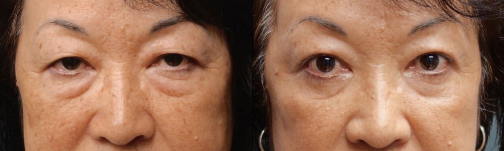 Asian Upper Eyelid and Lower Eyelid Blepharoplasty Patient 31-A 
