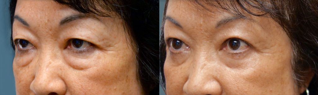 Asian Upper Eyelid and Lower Eyelid Blepharoplasty Patient 32-B 