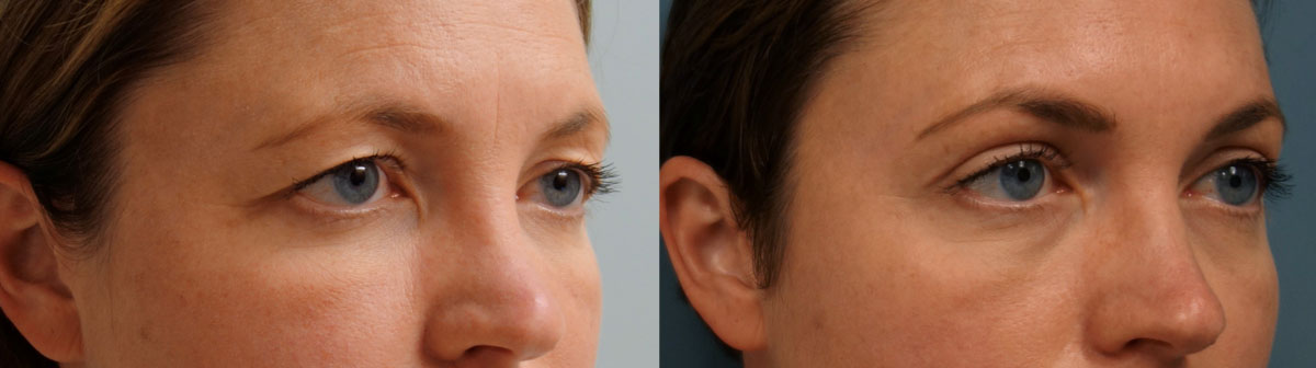 Bilateral Upper Eyelid Blepharoplasty, Left Upper Eyelid Ptosis Repair and Mini Brow Lift Patient 04-A 