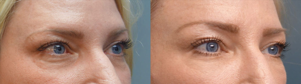 Bilateral Lower Eyelid Filler Patient 17 