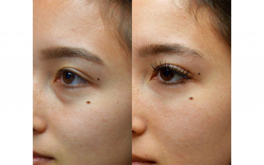 Bilateral Lower Eyelid Filler Asian Patient 06-B 