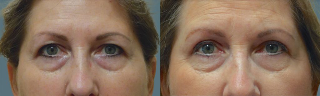 Upper Eyelid Blepharoplasty Patient 43-A 