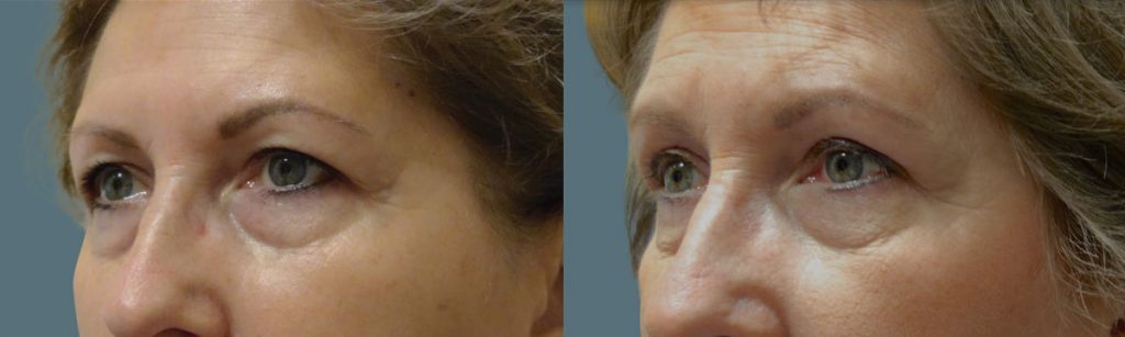 Upper Eyelid Blepharoplasty Patient 43-B 
