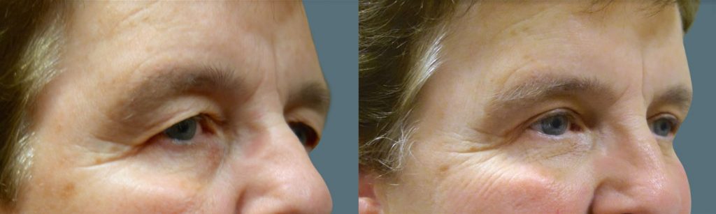 Upper Eyelid Blepharoplasty Patient 26-B 
