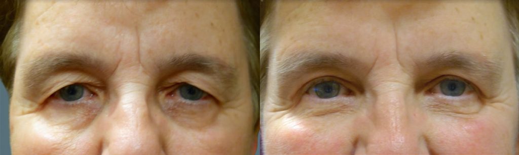 Upper Eyelid Blepharoplasty Patient 26-A 