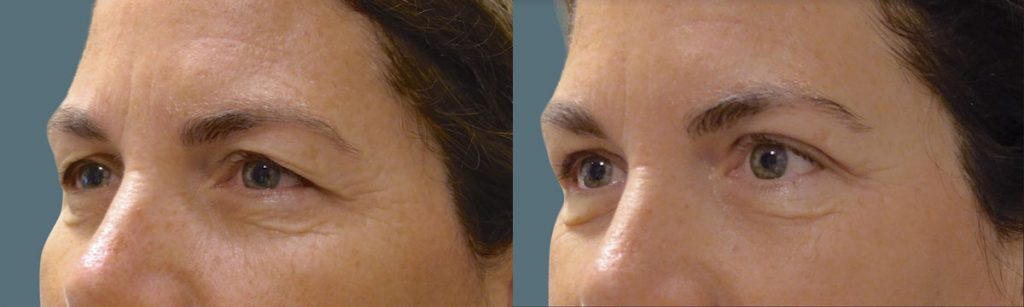 Upper Eyelid Blepharoplasty Patient 12 