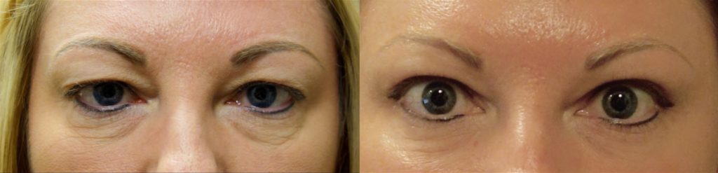 Upper and Lower Eyelid Blepharoplasty Patient 37-A 