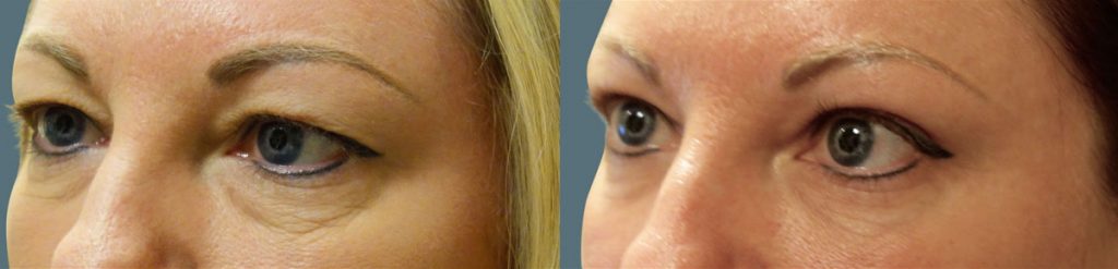 Upper and Lower Eyelid Blepharoplasty Patient 37-B 