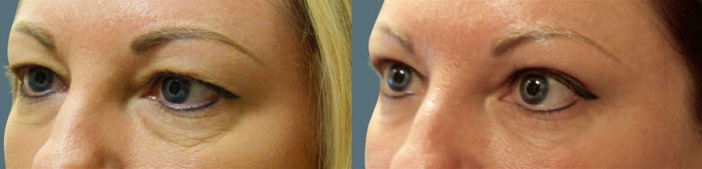 Upper and Lower Eyelid Blepharoplasty Patient 38-B 