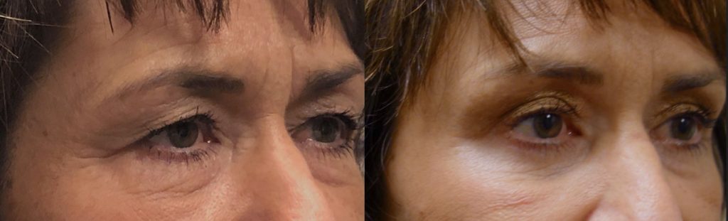 Upper Eyelid Blepharoplasty and Mini Brow Lift Patient 31-B 