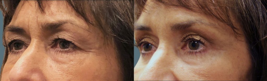 Upper Eyelid Blepharoplasty and Mini Brow Lift Patient 31-C 