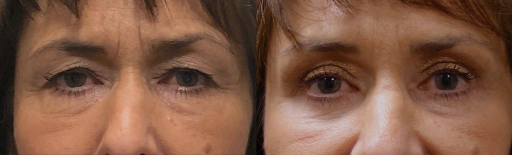 Upper Eyelid Blepharoplasty and Mini Brow Lift Patient 31-A 