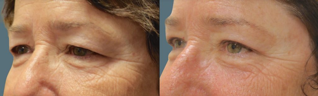 Upper Eyelid Blepharoplasty Patient 39-C 