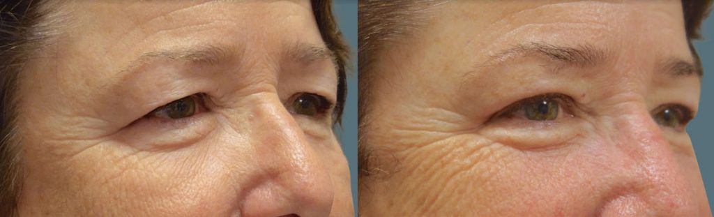 Upper Eyelid Blepharoplasty Patient 39-B 