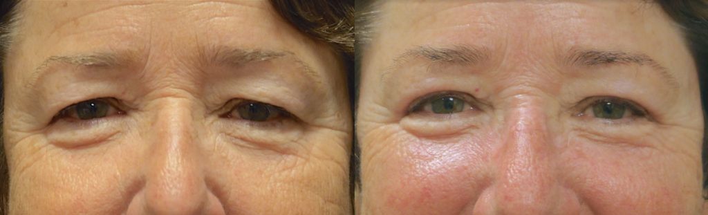 Upper Eyelid Blepharoplasty Patient 39-A 