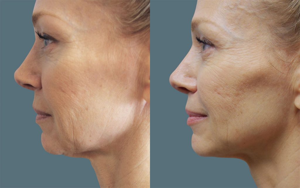 Facetite with Morpheus 8 Microneedling Of The Jawline and Jowls Patient 04-A 