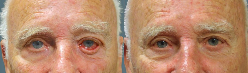 Left Lower Eyelid Ectropion Repair Patient 02-A 