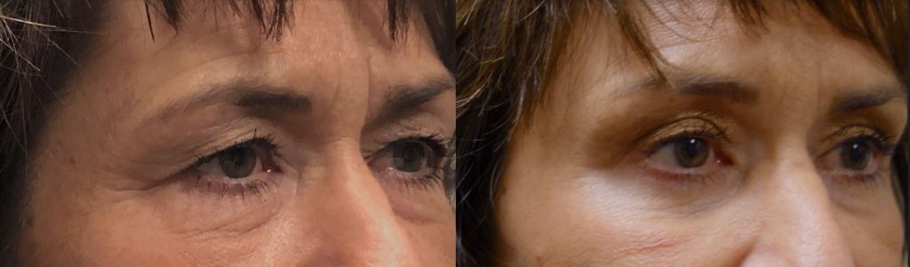 Upper Eyelid Blepharoplasty and Mini Brow Lift Patient 19-B 