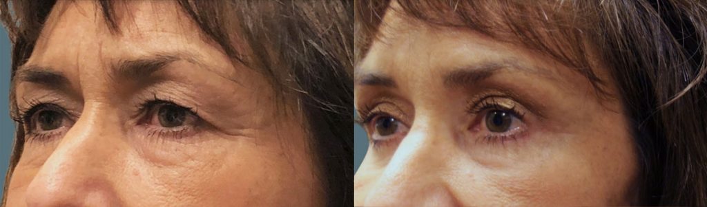 Upper Eyelid Blepharoplasty and Mini Brow Lift Patient 19-C 