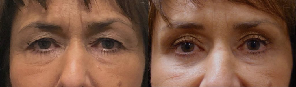 Upper Eyelid Blepharoplasty and Mini Brow Lift Patient 19-A 
