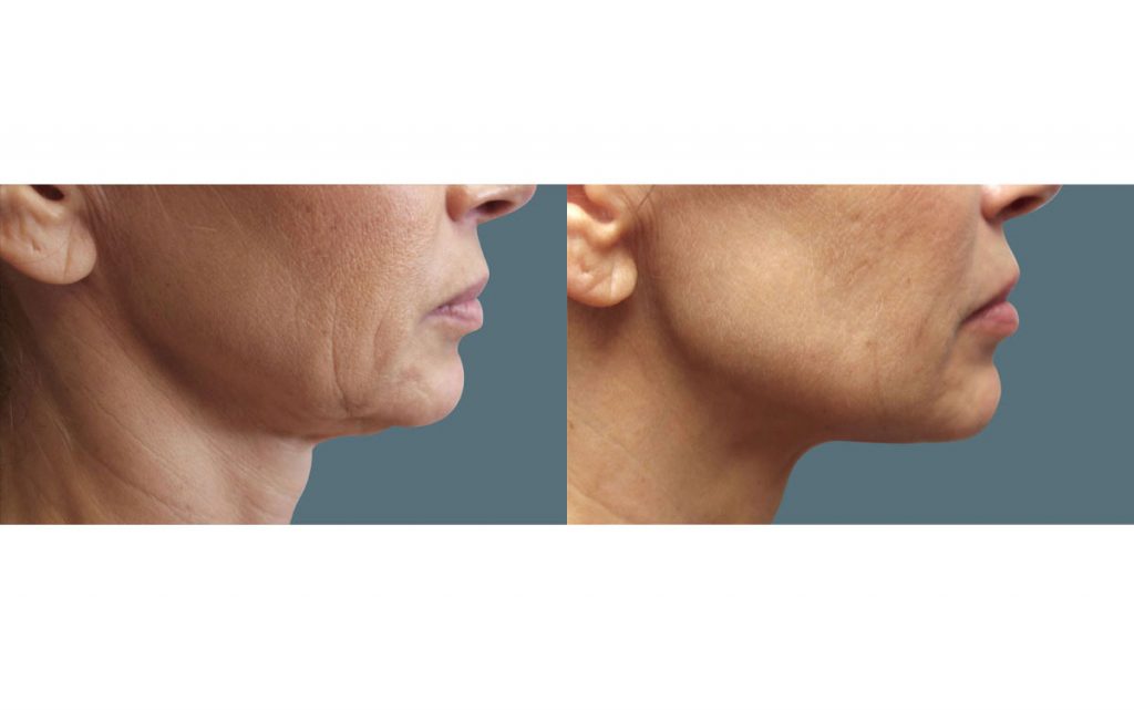 Facetite with Morpheus 8 Microneedling Of The Jawline and Jowls Patient 04-B 