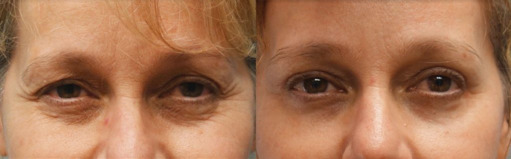 Co2 Laser Lower Eyelids Patient 02-A 