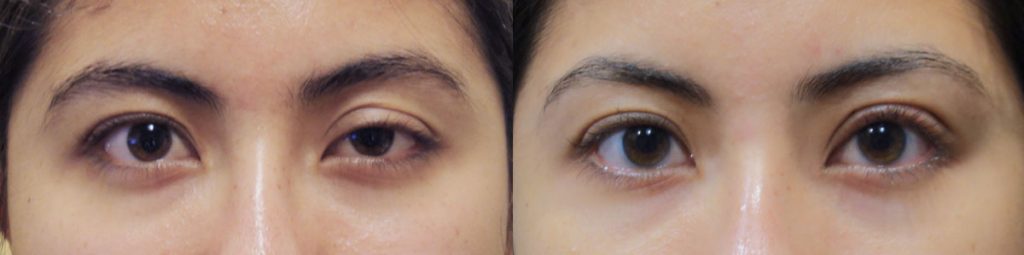 Left Upper Eyelid External Ptosis- Congenital Patient 03 