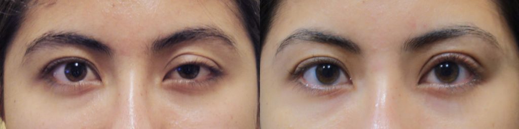 Left Upper Eyelid External Ptosis- Congenital Patient 03 
