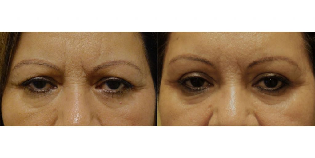 Bilateral Upper Eyelid External Ptosis Repair Patient 11-B 