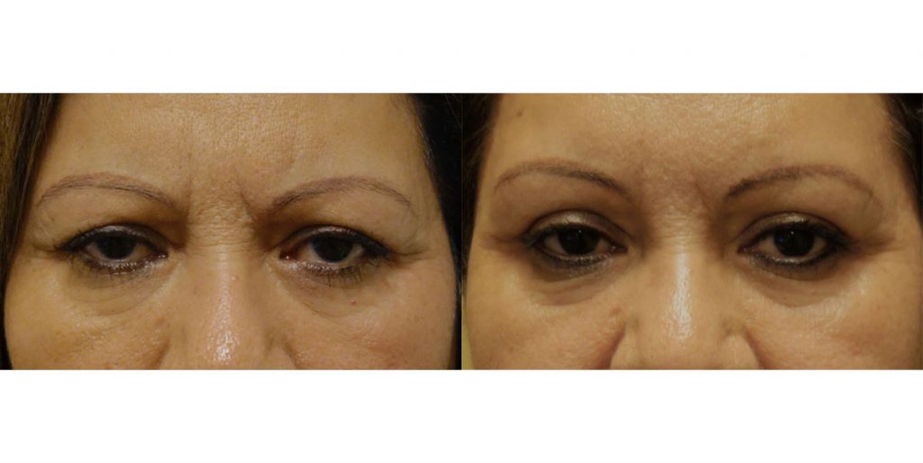 Bilateral Upper Eyelid External Ptosis Repair Patient 11-B 